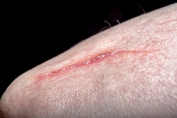 Nearly healed scar on the arm. Close-up of leather with a scratch. Photo in soft focus at high magnification.
