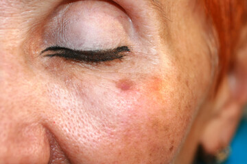 Skin pigmentation. Brown spots of pigmentation on the skin of the face.