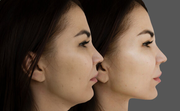 Get a Slimmer Neck with Neck Liposuction: Your Ultimate Guide