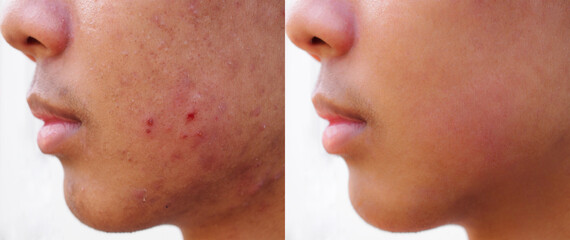 Image before and after spot red scar acne pimple treatment on face asian man.Problem skincare and...