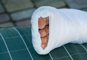 Obraz premium Broken leg in white plaster cast rests on a green checkered pillow. Close-up man leg with fingers. Fracture of leg after falling off the steps. The leg turned up and broke