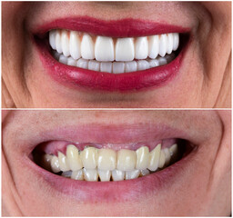 full mouth rehabilitation by crowns veneers and implants