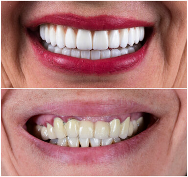 Full Mouth Rehabilitation By Crowns Veneers And Implants