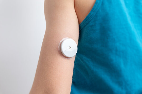 Blood Glucose Sensor On A Child's Arm.  Sensor For Remote Measurement Of Blood Glucose Levels Using NFC Technology On A Mobile Phone Or Reader