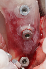 Three mounted implant dentals through a template