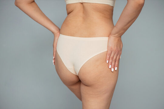 Young woman on a light background. Cellulite problem concept