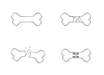 Broken bone fracture fixation plates, screws, nails, rods. Healing bone vector illustration. Anatomy graphic image