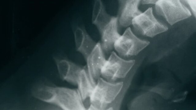 Neck x-ray close-up. Magnetic Resonance Image of Spinal Column, Skull Head. Doctor examining xray of spine bones. Healthcare and medicine concept.