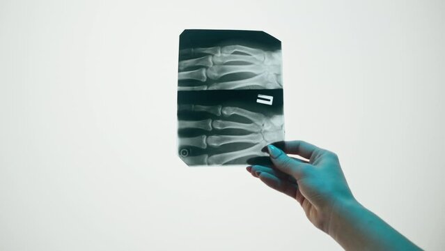 Hand fingers x-ray close-up. Magnetic Resonance Image of human arm. Doctor examining xray of palm bones. Healthcare and medicine concept.