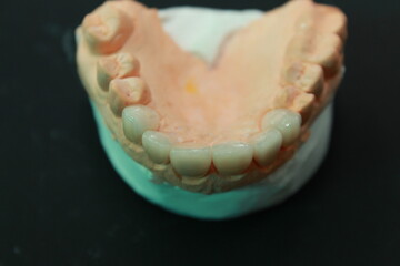 Veneers and crowns by dental technicians try-in the dental models before handing over to the patient insertion dentist.