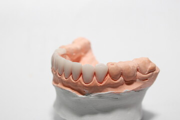 Veneers and crowns by dental technicians try-in the dental models before handing over to the patient insertion dentist.
