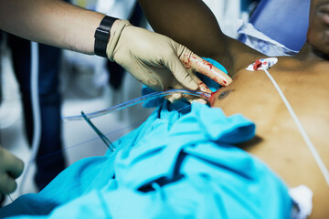 Restoring respiratory function with chest drainage. Cropped shot of a doctor inserting a tube into...