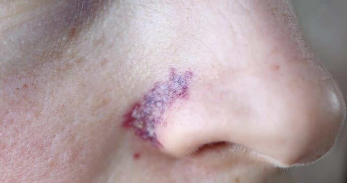 Removal of blood vessels on wings of nose with laser closeup