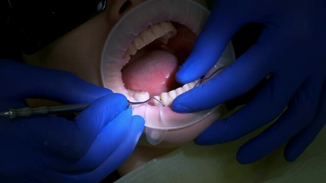 Dentist puts the thread to stop the bleeding between tooth and gum of the patient. Close-up of the oral cavity in the process of dental treatment. Dentistry, prosthetics concept. Orthodontist cure.