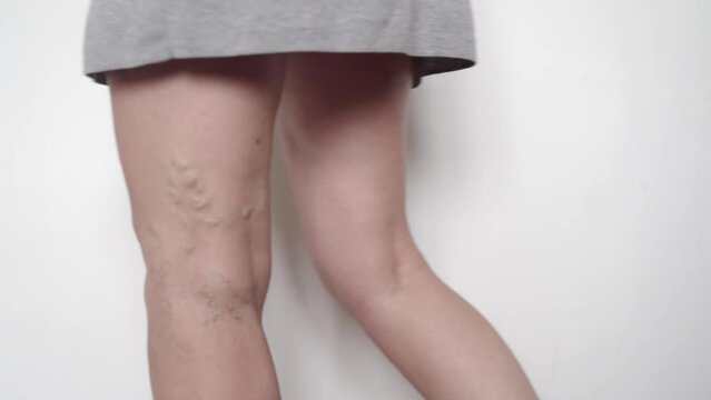 close up of woman legs with varicose veins. Spider vein texture on legs, vascular medical problem. Elderly woman care