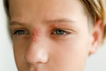 Large red rash on the nose and over the child's eye - dermatolonia, virus, infection, herpes, mucous membrane, selective focus - obrazy, fototapety, plakaty