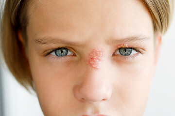 Rash on the face of a child, on the nose and eye, close-up: herpes, virus, infection, conjunctivitis, allergy - medical concept. - obrazy, fototapety, plakaty
