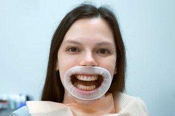 Portrait of happy woman with yellow teeth with retractor in her mouth is waiting dentist. She is in...