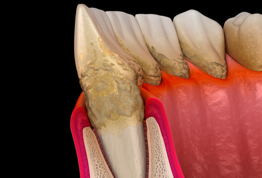 Periodontitis stage 1, gum recession, tartar. Medically accurate 3D illustration