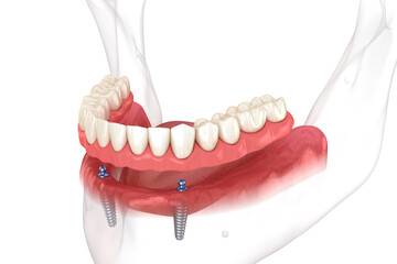 Mandibular removable prosthesis All on 2 system supported by implants with ball attachments. Medically accurate dental 3D illustration