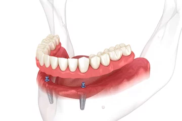Fotobehang Mandibular removable prosthesis All on 2 system supported by implants with ball attachments. Medically accurate dental 3D illustration © Alex Mit