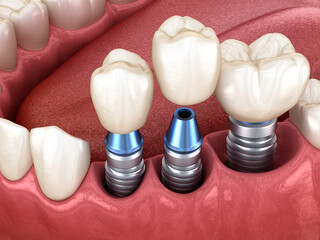 3 tooth crowns placement over 3 implants - concept. 3D illustration of human teeth and dentures - obrazy, fototapety, plakaty
