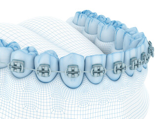 Braces and denture. Wire 3d model illustration