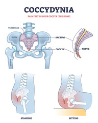 Coccydynia as pain felt in coccyx or tailbone anatomical outline diagram. Labeled educational back bone structure and painful nerve in standing or sitting positions vector illustration. Medical scheme - obrazy, fototapety, plakaty