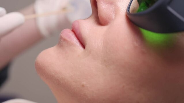 Professional cosmetologist applies gel over lip under nose. Extreme closeup. Laser hair removal in beauty salon.