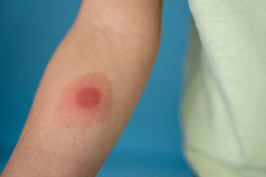 mantoux vaccination, Closeup view photography of kid's arm with red spot reaction to conducting Mantoux test