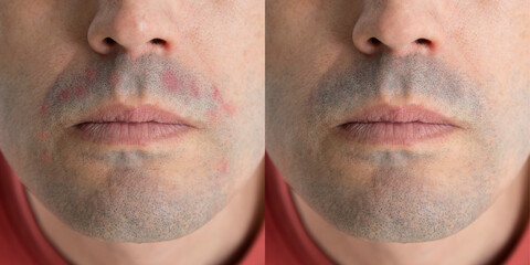 Photo with and without dermatitis. Concept of irritated skin in men after shaving. Photos before and after treatment - obrazy, fototapety, plakaty