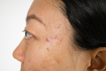 Portrait of worrying asian woman with problems of acne inflammation (Papule and Pustule) on her face. Conceptual of problems on woman skin.