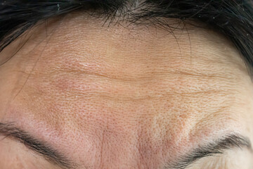 Close-up Woman's face with wrinkles on her forehead. The concept of collagen and facial injections. Menopause. Cropped image. Copy space and simulate.