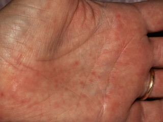 detail of scarlet fever in an adult caucasian man