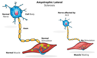 Amyotrophic Lateral Sclerosis Pathogenesis, Detailed Vector Illustration of Nerve and Muscle Cell Degeneration in White Background for Medical Education and Research.