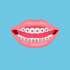Mouth and teeth with braces. Orthodontic dentistry concept. Alignment of teeth. Dental care. Vector illustration isolated on blue background.