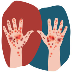 Two hands raised up. Manifestation of skin disease signs in people with white skin tone. Rash on both human hands. Irritation, rash, dermatitis. Design for medicine or dermatology, medical sites, app.