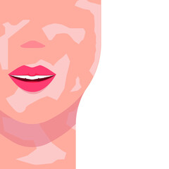 Skin of the face and neck with spots of vitiligo. Women's lips parted in a smile. Vector illustration, flat cartoon color design, isolated on white background, eps 10.