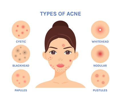 Isolated Pretty Brunette Woman with Problem Skin on Face. Teenager with Pimples. Zoom. Types of Acne. Flat Color Cartoon style. White background. Vector illustration for Medical and Cosmetology design