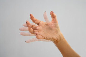Person Hand With Dystonia