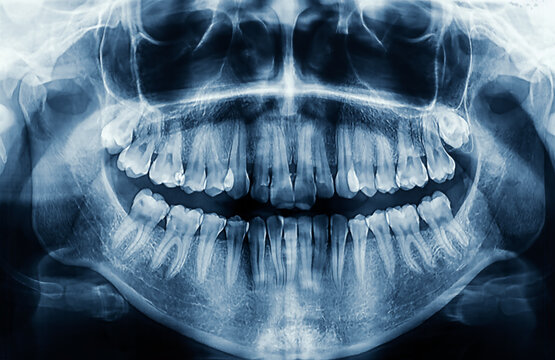 Panoramic dental tooth X-ray of a 26 year old teenage girl