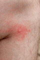 Fototapeta premium Inflamed Mosquito bite on a caucasian man's leg