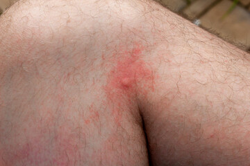 Selective focus on a mosquito bite on a caucasian man's leg