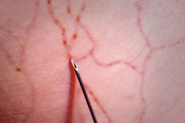 The hand of a drug addict. A needle from a drug syringe enters a vein close-up.