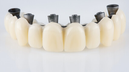 dental prosthesis of the upper jaw with a metal beam on a white background