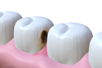 3D rendering of human tooth with caries, tooth decay and healthy tooth