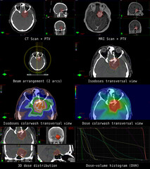 Illustration of a modern radiation plan for cancer therapy of a patient with a brain tumor (meningioma).