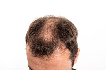 Obraz premium Close-up balding head of a young man on a white isolated background.
