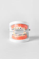 Model of jaw with braces on white background