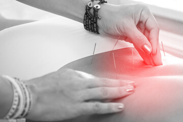 Close-up of female body with steel needles inserted during procedure of acupuncture therapy